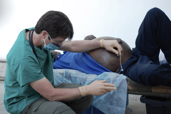 Dr. Jim draining fluid from a man's abdomen